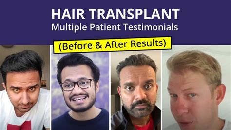 hair transplant testimonials.